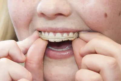 Zahnspangen für Kinder - Verbraucherinformation der ERGO Krankenversicherung