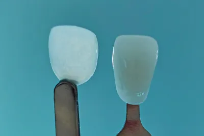 Boston Micro Fabrication will ultradünne kosmetische Zahnverblendungen auf den Markt bringen