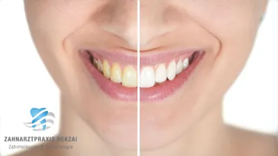 Zahnarzt Nekzai sorgt mit Bleaching in Hamburg Wandsbek für strahlend weiße Zähne